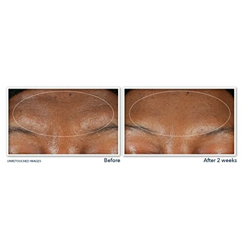 Comparison of a forehead before and after two weeks of treatment.