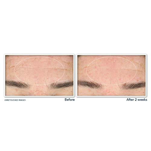 Before and after images of forehead showing wrinkle reduction over two weeks.