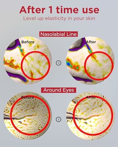 Comparison of skin elasticity before and after use, highlighting nasolabial line and around eyes.